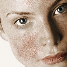 Skin Disorder & Pigmentation